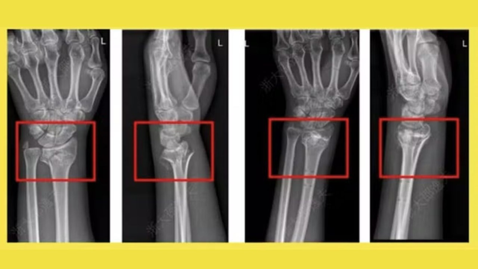 Cola óssea, Chineses, Fraturas, Cirurgias